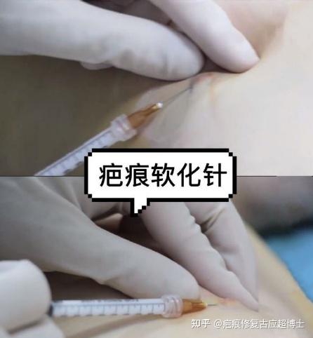 疤痕软化针的效果怎么样