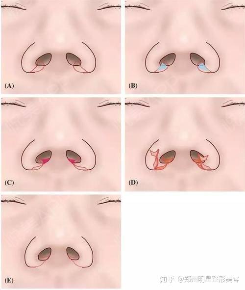 切口采取内切的方式,位置在鼻翼基底及鼻翼沟下部,局麻下适当切除