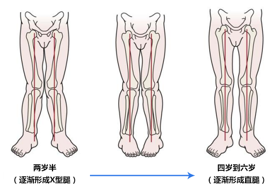 宝宝一岁之前都是o型腿,3-6岁是x型腿,这种说法是真的吗?