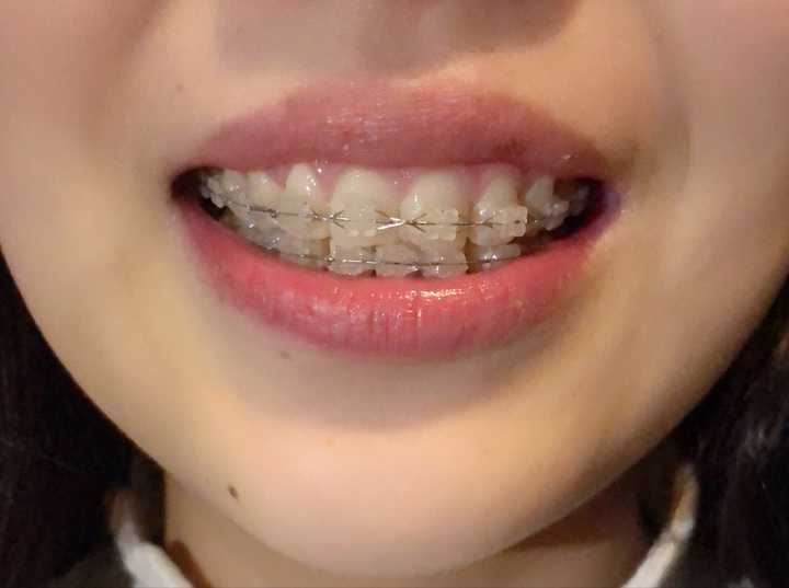 戴过牙套(矫正牙齿)的人脸型变了吗?
