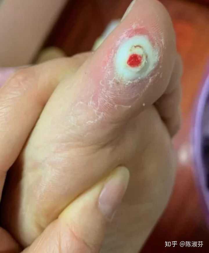 怎么治鸡眼?鸡眼会传染吗?为什么我脚上的鸡眼越来越多了?