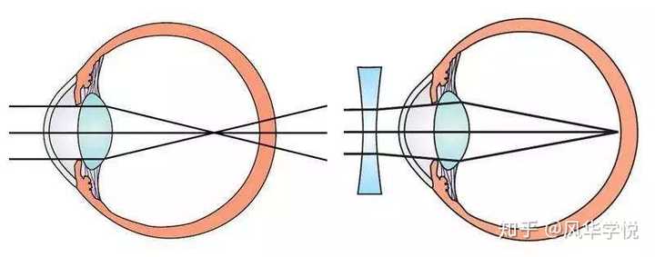 (近视矫正原理)