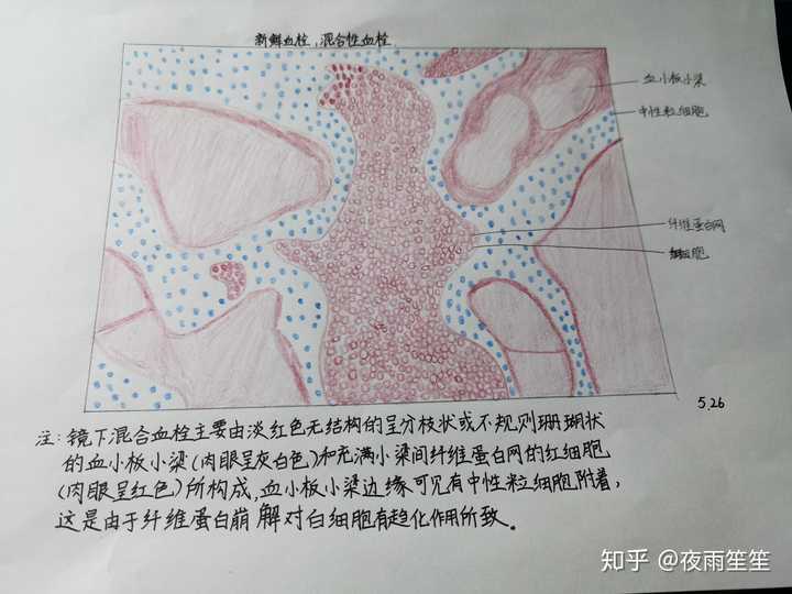 肉芽组织和血栓的红蓝铅笔手绘图怎么画?救救孩子吧!