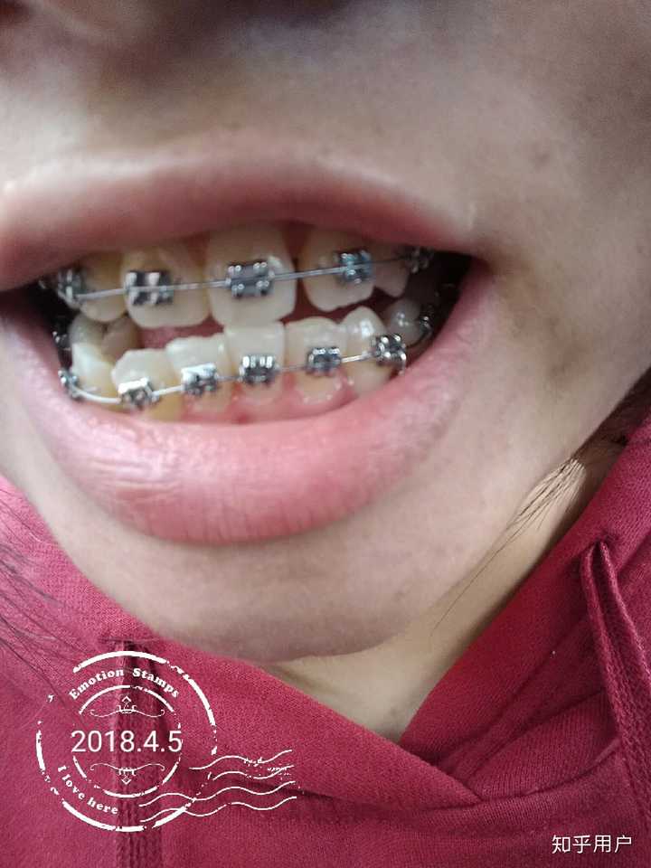 戴牙套一般要多久 知乎