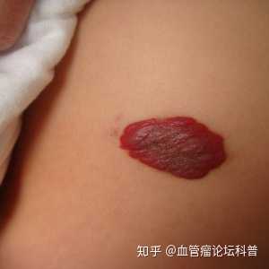 具体什么原因会导致血管瘤?