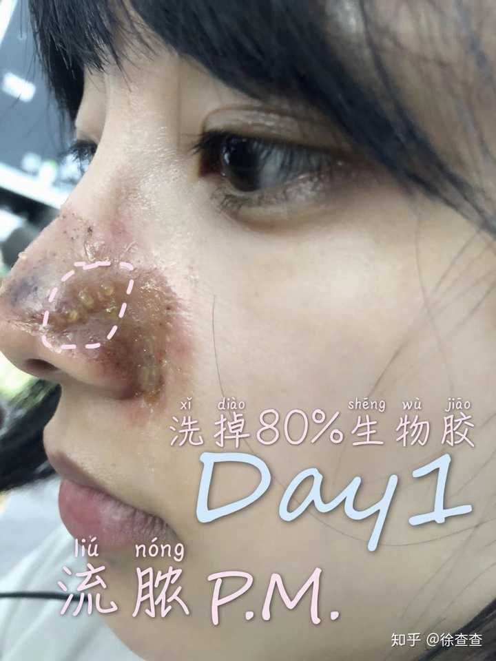 做完点阵激光应该注意些什么?