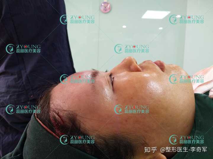 生长因子注射在鼻子山根出还能取出吗?