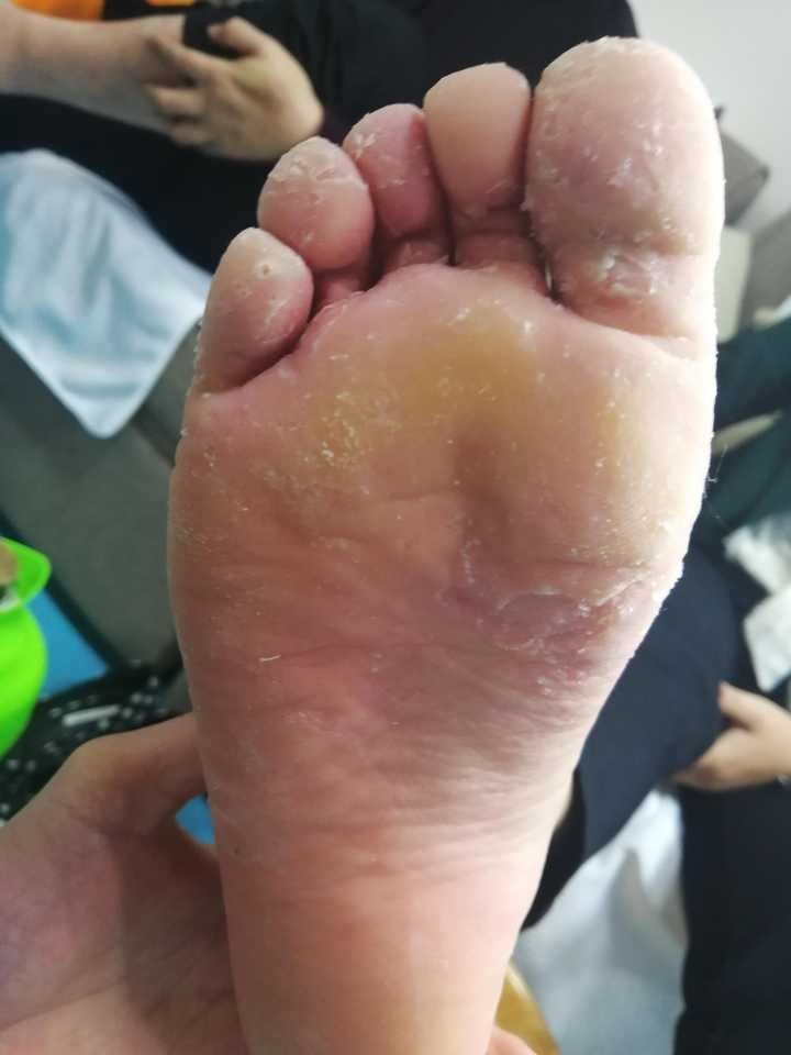 「足癣」是一种什么疾病?如何预防和治疗?