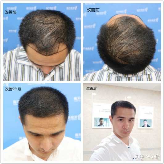 头顶秃了怎么办?