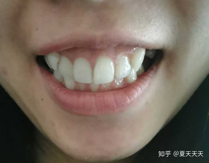 牙齿矫正后容貌真的会变好看吗?