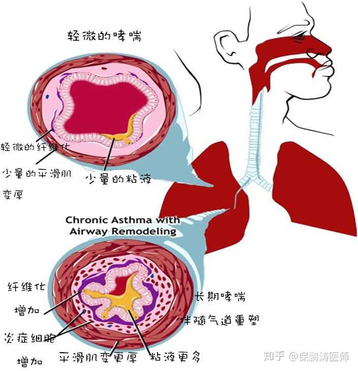 哮喘的起因是什么?