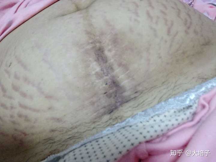 女人生完孩子后肚子的真实状态是怎样的?