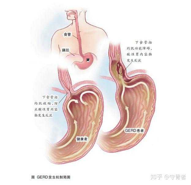反胃酸的时候怎么办?