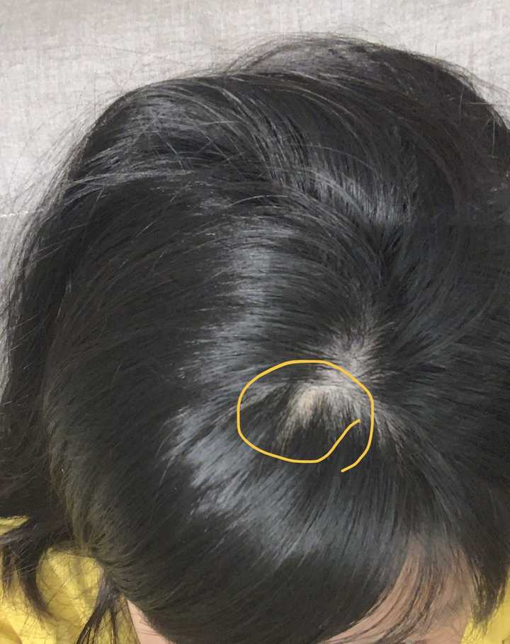 我这几根头发真是帮我挡了太多 承受了太多 头顶摸起来会有扎的手感