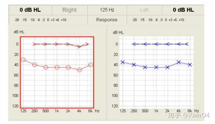 以一张纯音听力图为例,红色表示右耳,蓝色表示左耳.横坐标为频率,即