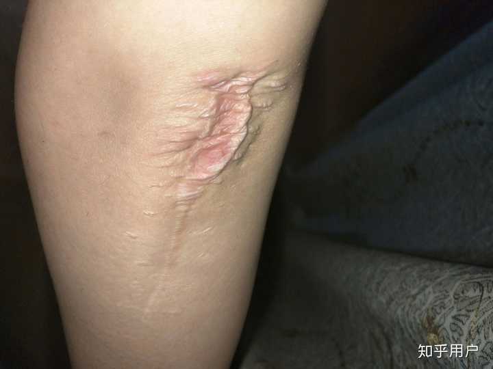 大家都是怎么看待身上有疤的?
