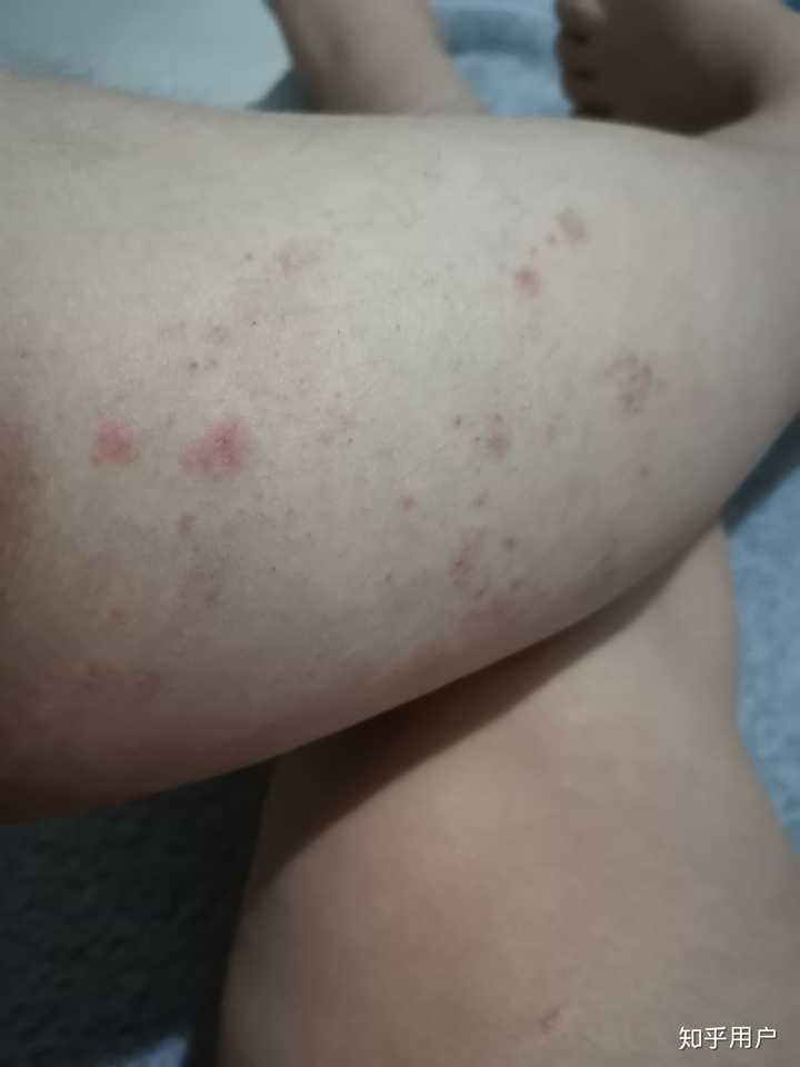 园子猪肉的注意以及平时要自愈的?糠疹玫瑰汤图片