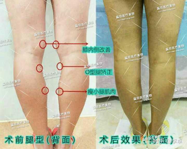 如何后天矫正不漂亮的腿型?