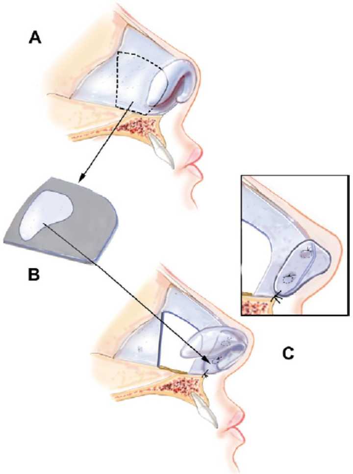 提取鼻中隔软骨延长鼻尖(来源:医学文献《asian rhinoplasty》)