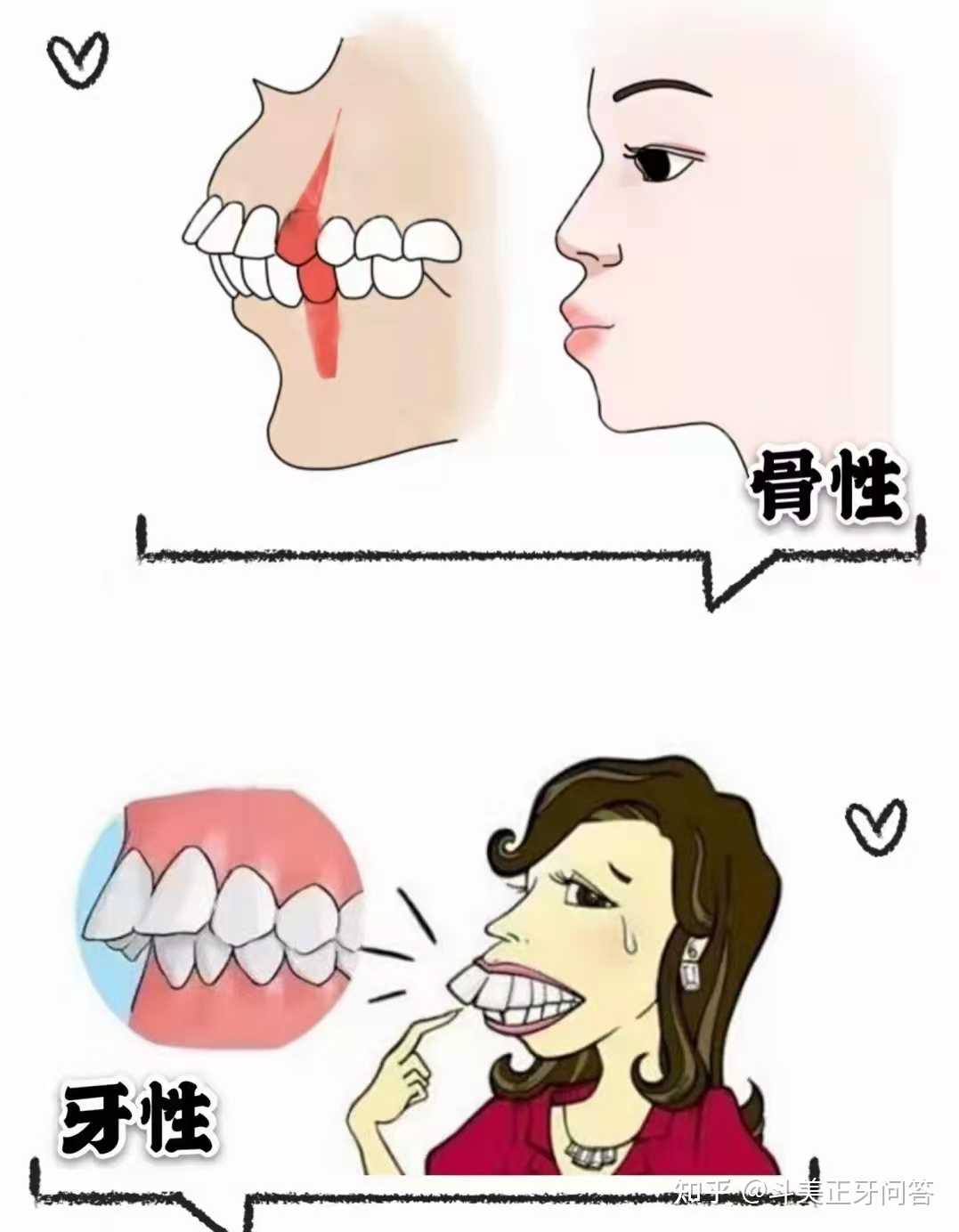 牙性前突vs骨性前突的区别和解决方法