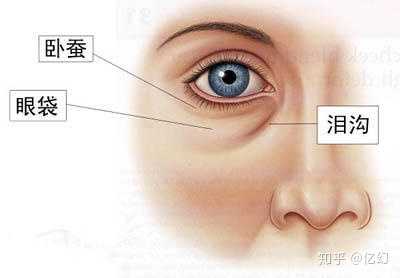泪沟是因为眼眶隔膜下缘的软组织萎缩,下垂,或者肌肉韧带交界处形成的
