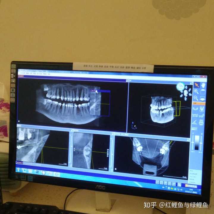 但是医生说我的牙齿情况还是不容乐观,我的牙根和一般人比又深又长