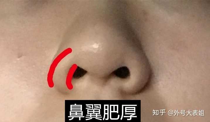 全切鼻翼 推鼻底皮瓣 特别肥厚的需要鼻翼肥厚削薄术,留疤概率大,可能