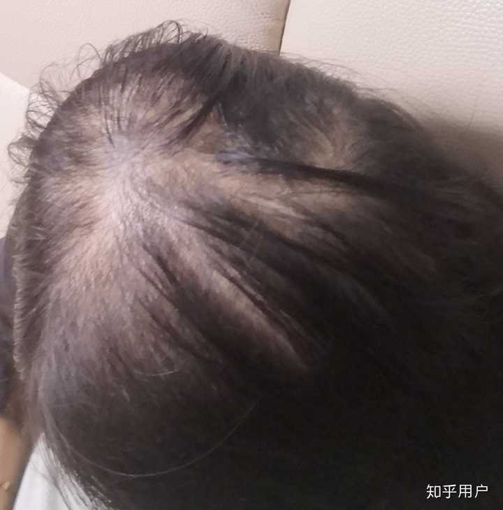 女生秃顶是怎样一种体验?