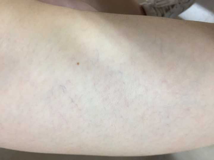 今年23岁,各位可以帮我看看[在大腿]这是毛细血管扩张吗?