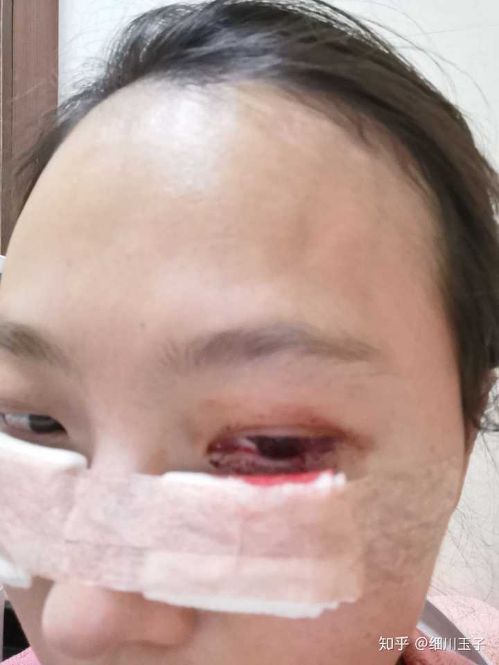 第二天就可以把包扎的纱布拿掉了.