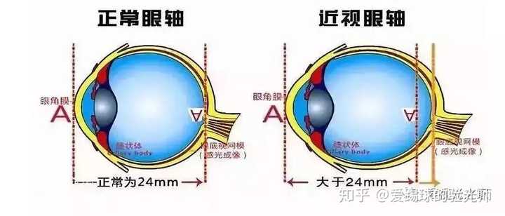 近视是因为眼轴增长导致视觉成像在视网膜之前.