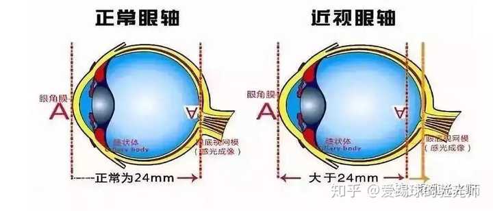 600多度近视 20天坚持每天早上看远处半个小时 视力能