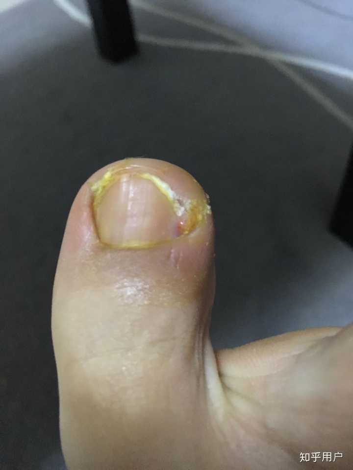 甲沟炎怎么自己处理哇?
