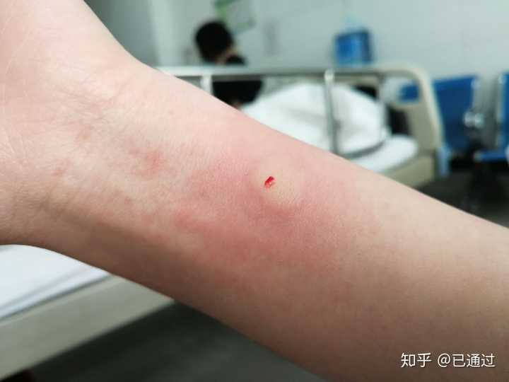 女生经历痔疮手术是怎样一种体验?