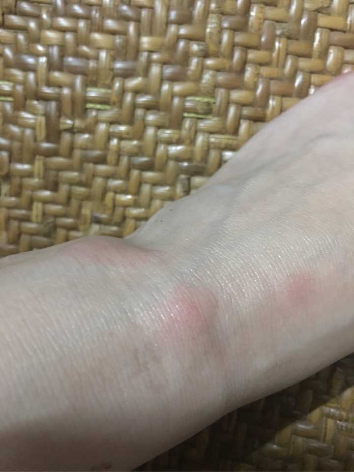 请问下这个到底是长的什么有告诉我是虫咬皮炎有告诉我是疱疹谢谢