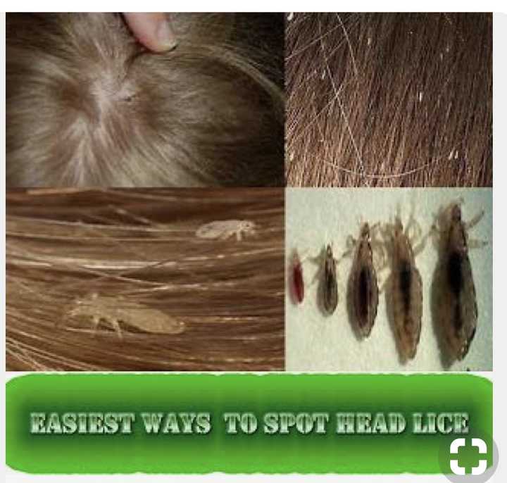 理发师说头发经常绑着容易出现毛管虫毛管虫是什么来的看到头发上有