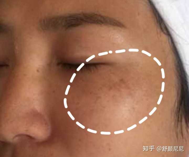 这其实是雀斑样痣~再看看这个,位置是不是长得与雀斑有点像?
