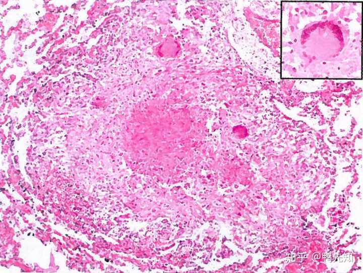 中央为干酪样坏死,这些坏死的成分阻碍了绝大多数的抗菌药物进入核心