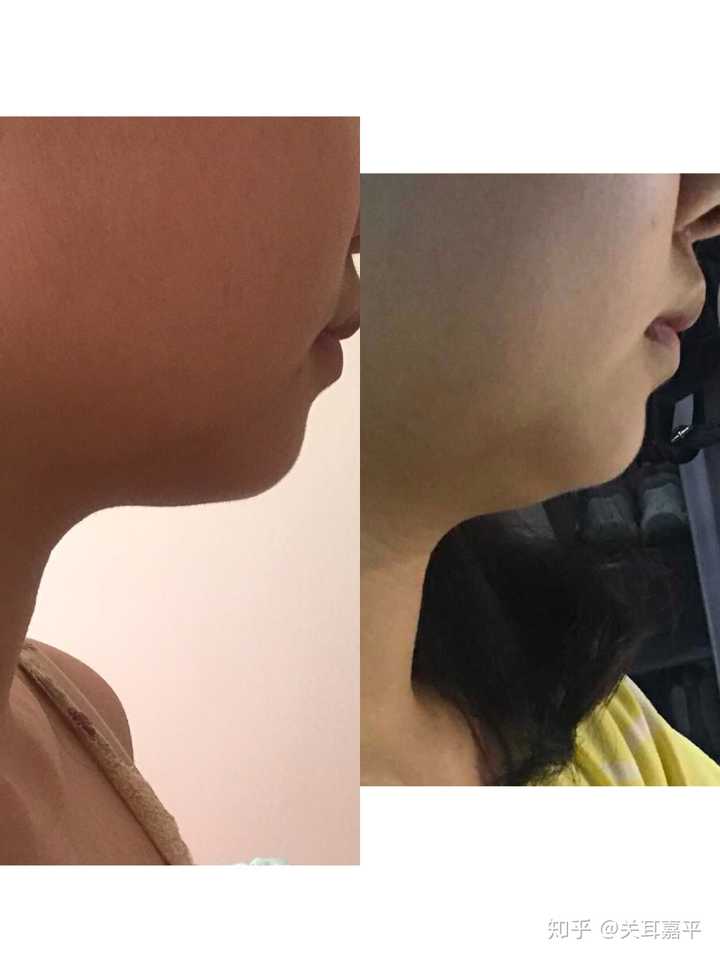 张嘴呼吸面容变丑能恢复吗?
