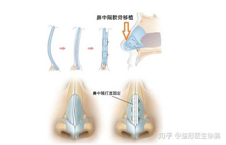 据软骨检测和实际情况考虑,手术方案为 达拉斯半肋隆鼻 鼻中隔矫正