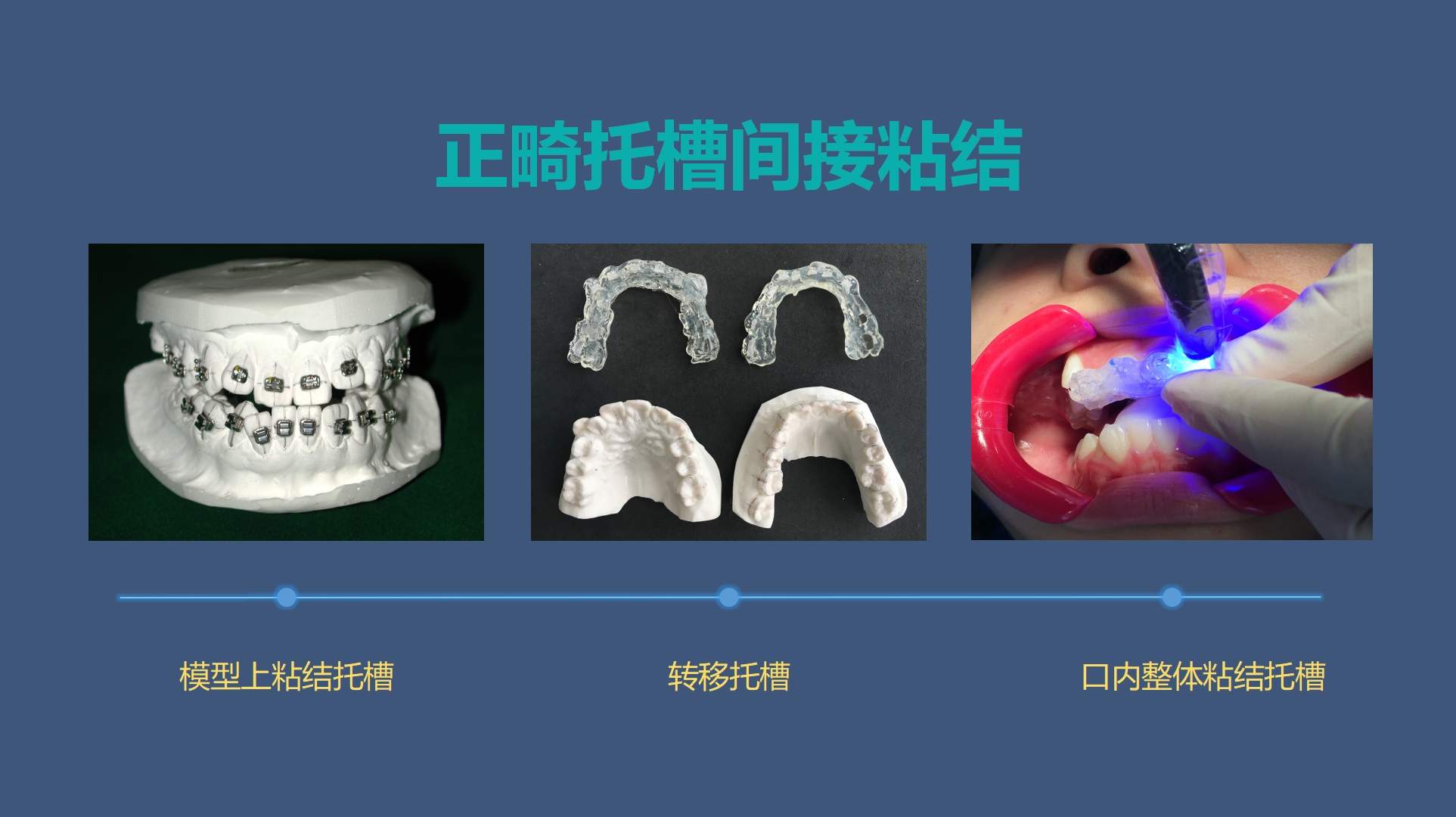 目前临床中托槽粘结我们常规使用间接粘结… - 知乎
