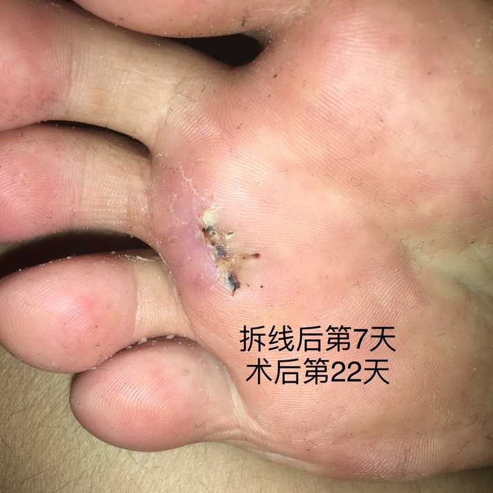 长了鸡眼要怎么治疗比较好呢?