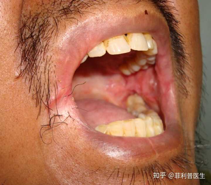 嚼摈榔引起的黏膜下纤维化,导致口腔黏膜收缩,限制了患者的张口幅度