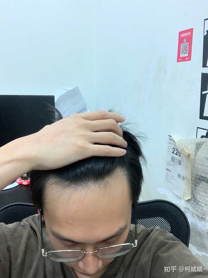 这样算是m型脱发吗?