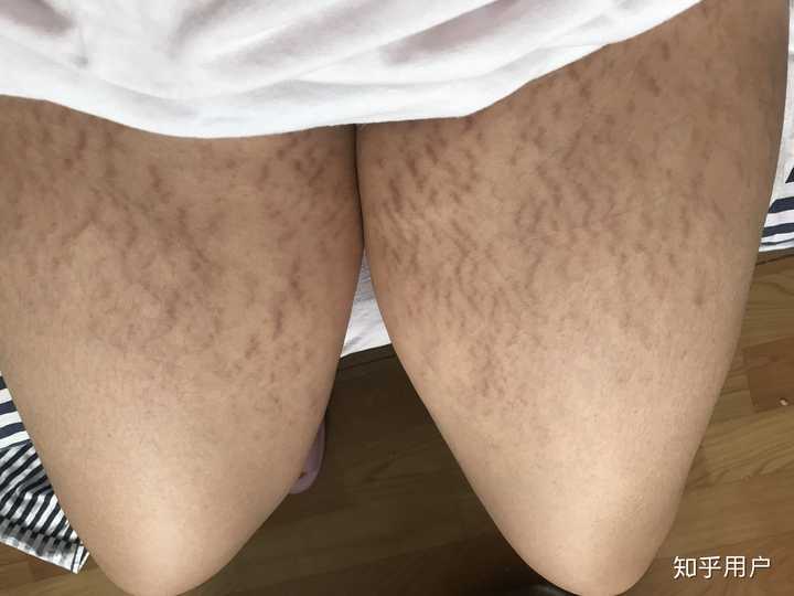 不知道身上有肥胖纹的女生,心里都是什么样的感受?