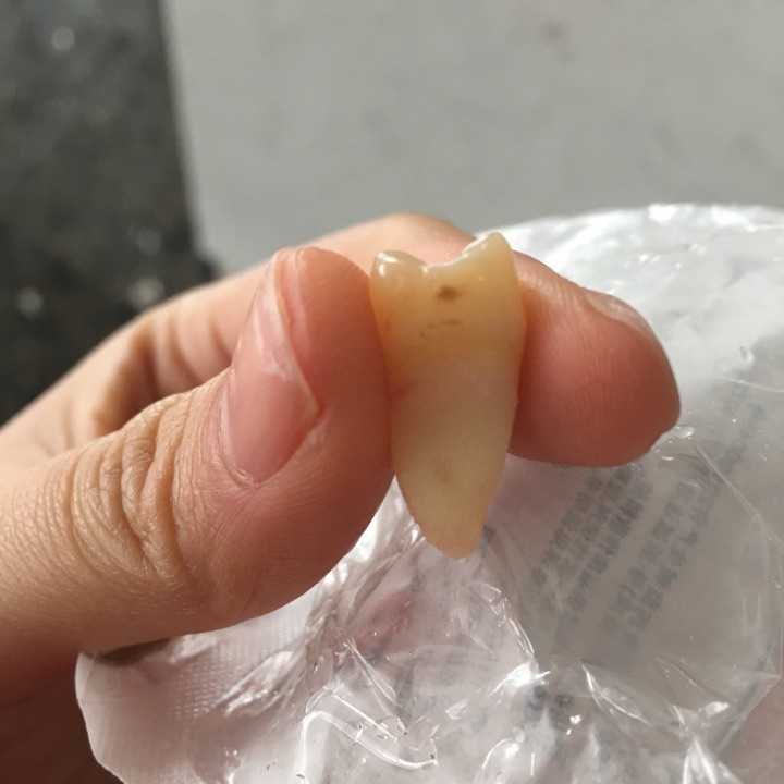 拔牙是一种怎么样的体验?
