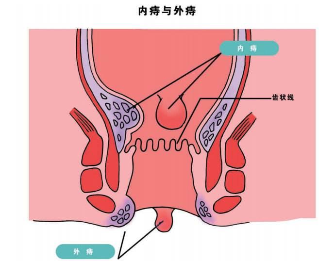 临床上一般把痔疮分为四型,轻度(Ⅰ型),中度(Ⅱ型)是不需要手术治疗