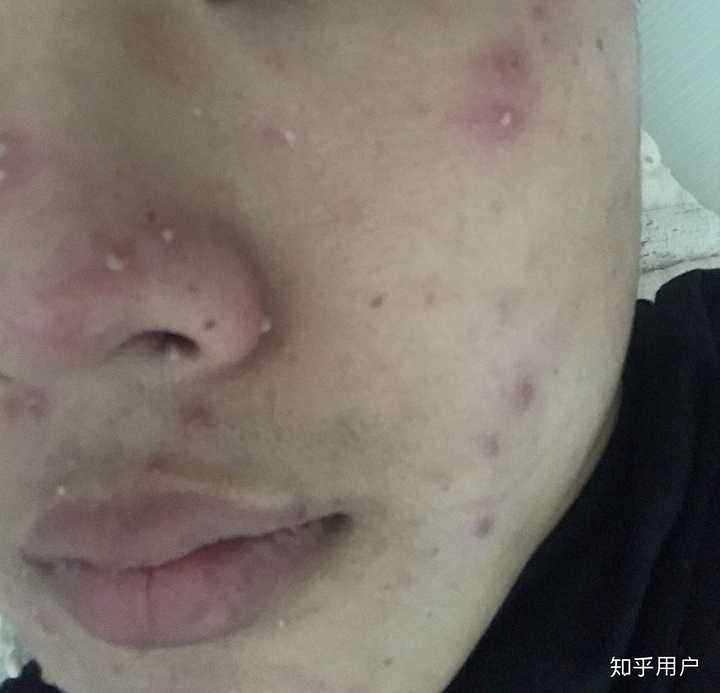 成人长水痘是什么样的经历