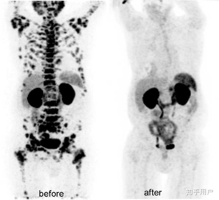 这个是前列腺癌骨转移治疗前后