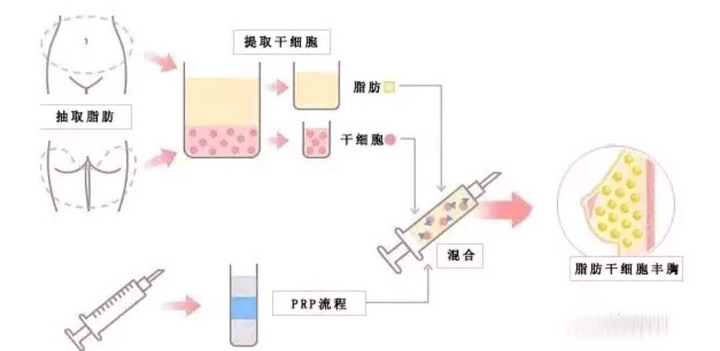 所以,脂肪隆胸最主要考核的是:脂肪存活率